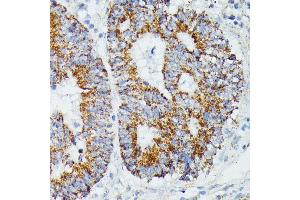 Immunohistochemistry of paraffin-embedded human colon carcinoma using IVD antibody (ABIN7268031) at dilution of 1:100 (40x lens).