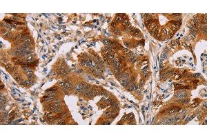 Immunohistochemistry of paraffin-embedded Human gastic cancer using ALDH3A1 Polyclonal Antibody at dilution of 1:55 (ALDH3A1 抗体)