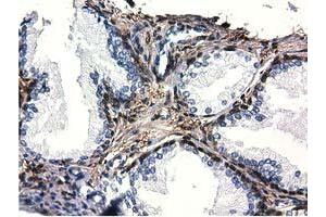 Immunohistochemical staining of paraffin-embedded Adenocarcinoma of Human ovary tissue using anti-QPRT mouse monoclonal antibody. (QPRT 抗体)