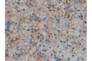 DAB staining on IHC-P; Samples: Human Renal cancer Tissue (TOR1AIP2 抗体  (AA 249-476))