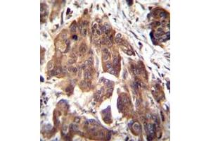 Immunohistochemistry analysis in formalin fixed and paraffin embedded human bladder carcinoma reacted with  Glomulin Antibody (C-term) followed by peroxidase conjugation of the secondary antibody and DAB staining. (GLMN 抗体  (C-Term))