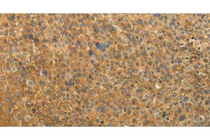 Immunohistochemistry of paraffin-embedded Human liver cancer tissue using RAB35 Polyclonal Antibody at dilution 1:50 (RAB35 抗体)