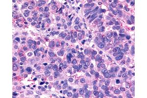 Anti-MRGX1 / MRGPRX1 antibody IHC of human Ovary, Carcinoma. (MRGPRX1 抗体  (N-Term))