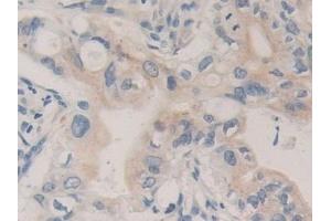 Detection of CPB1 in Human Bile duct cancer Tissue using Polyclonal Antibody to Carboxypeptidase B1, Tissue (CPB1) (CPB1 抗体  (AA 111-417))