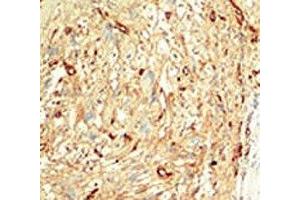 IHC analysis of FFPE human breast carcinoma tissue stained with the MST1 antibody (STK4 抗体  (AA 385-415))
