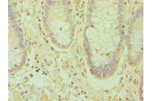 Immunohistochemistry of paraffin-embedded human colon cancer using ABIN7151874 at dilution of 1:100 (Ephrin A1 抗体  (AA 19-182))