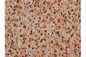 IHC image of ABIN7171666 diluted at 1:300 and staining in paraffin-embedded human glioma performed on a Leica BondTM system. (Tiparp 抗体  (AA 74-178))