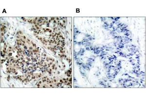 Immunohistochemical staining of paraffin-embbeded human breast carcinoma tissue using FOXO1 (phospho S256) polyclonal antibody  (A) or preincubated with blocking peptide (B). (FOXO1 抗体  (pSer256))