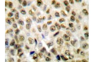 Immunohistochemistry analyzes of Histone H1 antibody in paraffin-embedded human lung carcinoma tissue. (Histone H1 抗体)