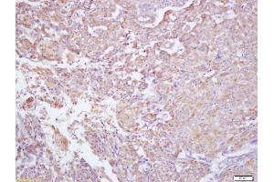 Formalin-fixed and paraffin embedded human labeled with Anti-IFNGR2 Polyclonal Antibody, Unconjugated (ABIN749483) at 1:200 followed by conjugation to the secondary antibody and DAB staining (RTN4RL2 抗体  (AA 241-337))