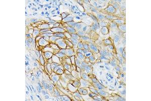 Immunohistochemistry of paraffin-embedded human lung cancer using GRIK2 Rabbit mAb (ABIN7267415) at dilution of 1:100 (40x lens). (GRIK2 抗体)