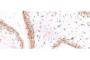 Immunohistochemistry of paraffin-embedded Human breast cancer tissue using CBFA2T2 Polyclonal Antibody at dilution of 1:60(x200) (CBFA2T2 抗体)