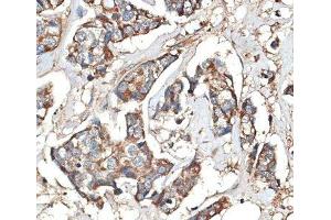 Immunohistochemistry of paraffin-embedded Human mammary cancer using KRT81 Polyclonal Antibody at dilution of 1:100 (40x lens). (KRT81 抗体)