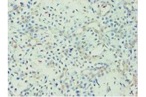 Immunohistochemistry of paraffin-embedded human breast cancer using ABIN7144436 at dilution of 1:100 (APOL1 抗体  (AA 179-398))