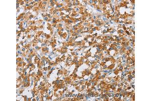 Immunohistochemistry of Human liver cancer using BDH1 Polyclonal Antibody at dilution of 1:60 (BDH1 抗体)