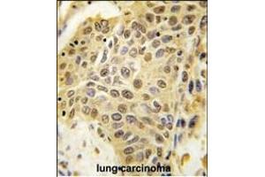 Formalin-fixed and paraffin-embedded human lung carcinoma tissue reacted with SENP5 Antibody (C-term) (ABIN388050 and ABIN2845616) , which was peroxidase-conjugated to the secondary antibody, followed by DAB staining. (SENP5 抗体  (C-Term))