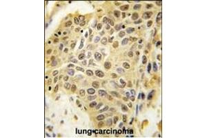 Formalin-fixed and paraffin-embedded human lung carcinoma tissue reacted with SENP5 Antibody (C-term) (ABIN388050 and ABIN2845616) , which was peroxidase-conjugated to the secondary antibody, followed by DAB staining.