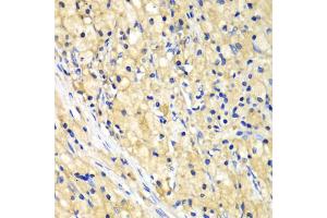 Immunohistochemistry of paraffin-embedded human lung cancer using NUP62 antibody (ABIN5971334) at dilution of 1/100 (40x lens). (NUP62 抗体)