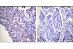 Immunohistochemistry analysis of paraffin-embedded human breast carcinoma, using Caldesmon (Phospho-Ser789) Antibody. (Caldesmon 抗体  (pSer789))