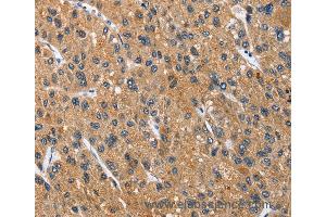 Immunohistochemistry of Human thyroid cancer using CEACAM3 Polyclonal Antibody at dilution of 1:70 (CEACAM3 抗体)