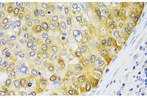 Immunohistochemistry of paraffin-embedded Human liver cancer using PA2G4 Polyclonal Antibody at dilution of 1:100 (40x lens). (PA2G4 抗体)