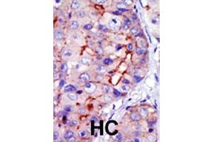 Formalin-fixed and paraffin-embedded human hepatocellular carcinoma tissue reacted with CAMK1D polyclonal antibody  , which was peroxidase-conjugated to the secondary antibody, followed by DAB staining. (CAMK1D 抗体  (C-Term))