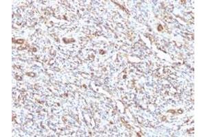 Immunohistochemical staining (Formalin-fixed paraffin-embedded sections) of human rhabdomyosarcoma with VIM monoclonal antibody, clone VM1170 . (Vimentin 抗体)