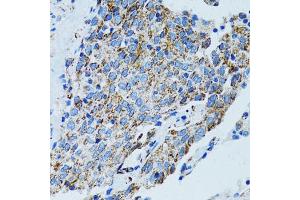 Immunohistochemistry of paraffin-embedded human lung cancer using MRPL28 antibody (ABIN5973497) at dilution of 1/100 (40x lens). (MRPL28 抗体)