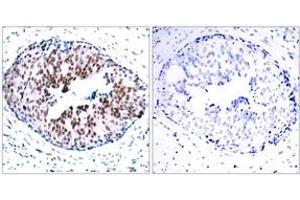 Immunohistochemistry analysis of paraffin-embedded human breast carcinoma, using STAT5A (Phospho-Ser780) Antibody. (STAT5A 抗体  (pSer780))