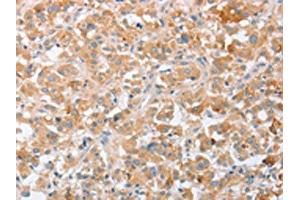 The image on the left is immunohistochemistry of paraffin-embedded Human thyroid cancer tissue using ABIN7131058(SIGLEC9 Antibody) at dilution 1/40, on the right is treated with fusion protein. (SIGLEC9 抗体)