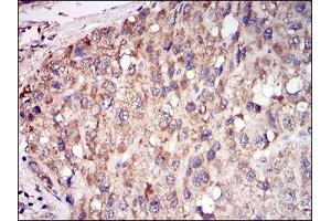Immunohistochemical analysis of paraffin-embedded liver cancer tissues using ACP5 mouse mAb with DAB staining. (ACP5 抗体  (AA 221-325))