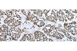 Immunohistochemistry of paraffin-embedded Human esophagus cancer tissue using CARTPT Polyclonal Antibody at dilution of 1:25(x200) (CARTPT 抗体)