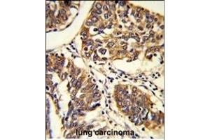 Formalin-fixed and raffin-embedded human lung carcinoma reacted with BPC1 Antibody (Center), which was peroxidase-conjugated to the secondary antibody, followed by DAB staining.