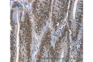 Immunohistochemistry of Human lung cancer using GNRH1 Polyclonal Antibody at dilution of 1:65 (GNRH1 抗体)