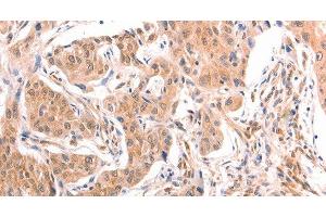 Immunohistochemistry of paraffin-embedded Human lung cancer tissue using TNF beta Polyclonal Antibody at dilution 1:50 (LTA 抗体)