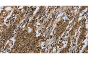 Immunohistochemistry of paraffin-embedded Human gastric cancer using RAP1B Polyclonal Antibody at dilution of 1:50 (RAP1B 抗体)