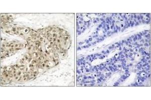 Immunohistochemistry analysis of paraffin-embedded human breast carcinoma, using CDC25C (Phospho-Ser216) Antibody. (CDC25C 抗体  (pSer216))