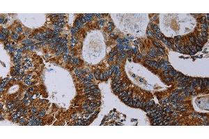 Immunohistochemistry of paraffin-embedded Human colon cancer using NDUFA4 Polyclonal Antibody at dilution of 1:40 (NDUFA4 抗体)