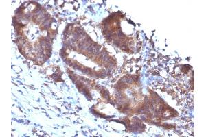 Formalin-fixed, paraffin-embedded human Colon Carcinoma stained with Transgelin Monoclonal Antibody (TAGLN/247) (Transgelin 抗体)