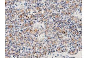 Immunohistochemical staining of paraffin-embedded Carcinoma of Human thyroid tissue using anti-LACTB2 mouse monoclonal antibody. (LACTB2 抗体)