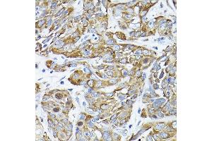 Immunohistochemistry of paraffin-embedded human esophageal cancer using CC2D1A Rabbit pAb (ABIN1679010, ABIN3019218, ABIN3019219 and ABIN6220767) at dilution of 1:200 (40x lens). (CC2D1A 抗体  (AA 1-150))