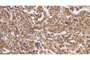 Immunohistochemistry of paraffin-embedded Human liver cancer using KCNG2 Polyclonal Antibody at dilution of 1:40 (Kcng2 抗体)