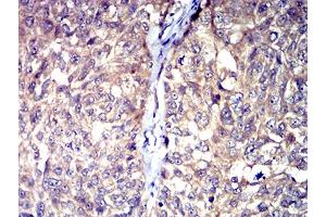 Immunohistochemical analysis of paraffin-embedded bladder cancer tissues using HTR3A mouse mAb with DAB staining. (Serotonin Receptor 3A 抗体  (AA 24-157))