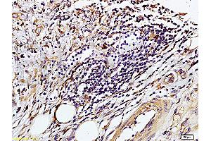 Formalin-fixed and paraffin embedded human colon carcinoma labeled with Rabbit Anti-TIMP-1(NT) Polyclonal Antibody, Unconjugated (ABIN668331) at 1:200 followed by conjugation to the secondary antibody and DAB staining. (TIMP1 抗体  (AA 103-207))