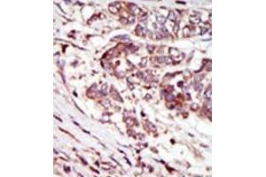 Formalin-fixed and paraffin-embedded human cancer tissue (hepatocarcinoma) reacted with the primary antibody, which was peroxidase-conjugated to the secondary antibody, followed by AEC staining. (CAMK1G 抗体  (C-Term))