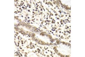 Immunohistochemistry of paraffin-embedded human gastric cancer using LMNB2 Antibody (ABIN2563696) at dilution of 1:200 (40x lens). (Lamin B2 抗体)