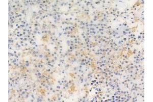 PSD93 Antibody at 1/100 staining human pituitary adenoma by IHC-P. (DLG2 抗体  (N-Term))