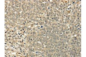 The image on the left is immunohistochemistry of paraffin-embedded Human ovarian cancer tissue using ABIN7128017(SIAH1 Antibody) at dilution 1/35, on the right is treated with fusion protein. (SIAH1 抗体)