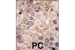 Formalin-fixed and paraffin-embedded human prostate carcinoma tissue reacted with PI4K2B polyclonal antibody  , which was peroxidase-conjugated to the secondary antibody, followed by DAB staining. (PI4K2B 抗体  (N-Term))