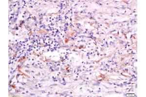 Formalin-fixed and paraffin embedded human lung carcinoma labeled with Anti-GRASP Polyclonal Antibody, Unconjugated  at 1:200 followed by conjugation to the secondary antibody and DAB staining. (Steppke (STEP) (AA 156-260) 抗体)